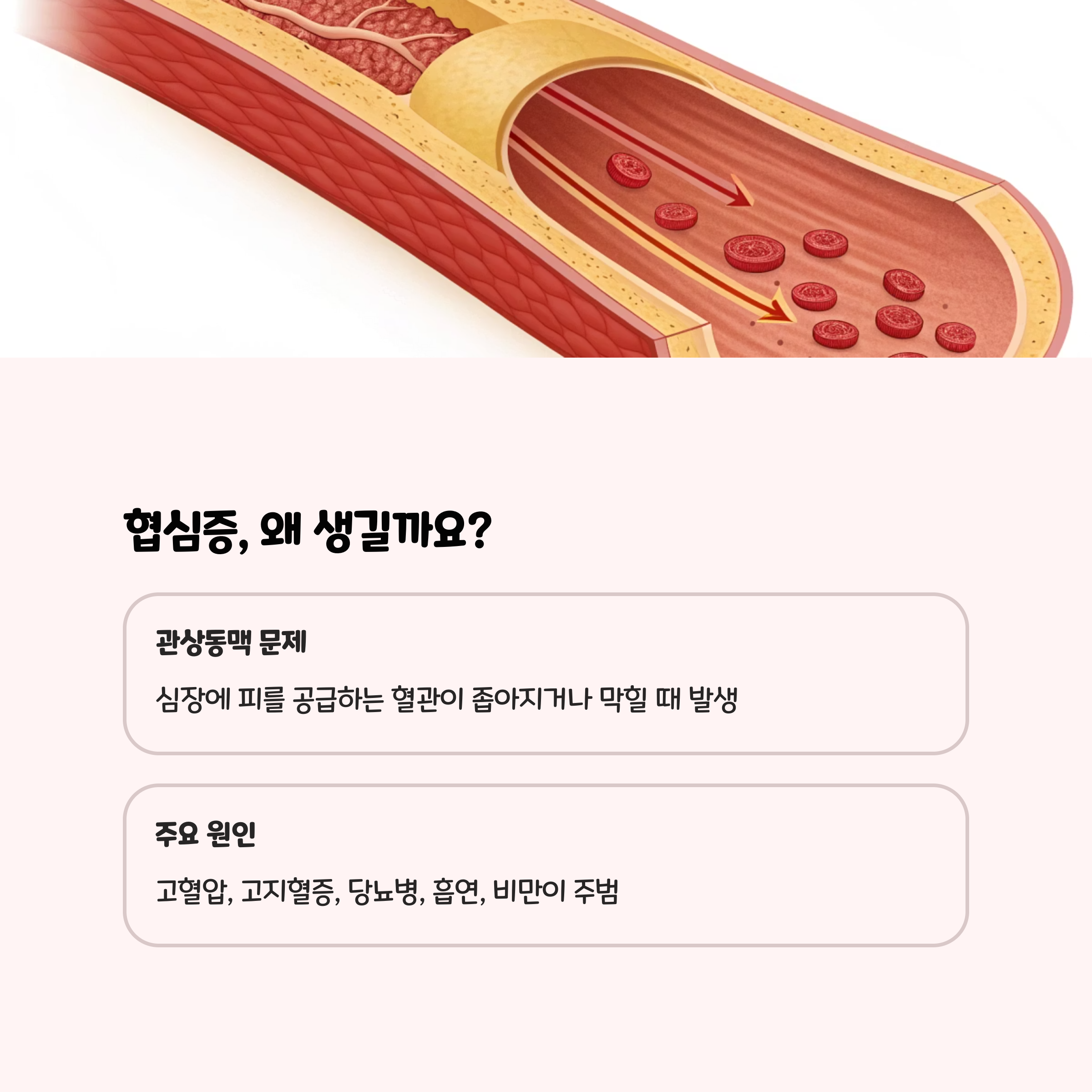 협심증, 왜 생길까요? 그리고 초기 증상은? 🤔