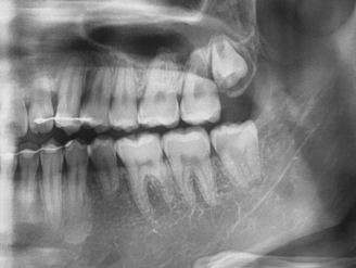 사랑니발치 해야하는 이유