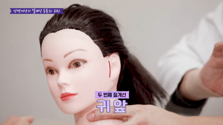 신사역성형외과 안면거상흉터 귀앞 절개