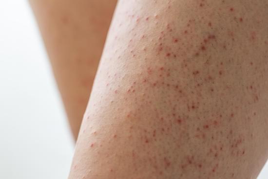모공각화증(Keratosis Pilaris)의 관리