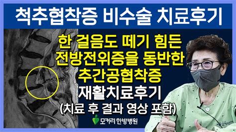 경추협착증