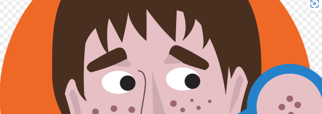 비립종 : 눈 주위나 이마, 볼 부분에 많이 생김.