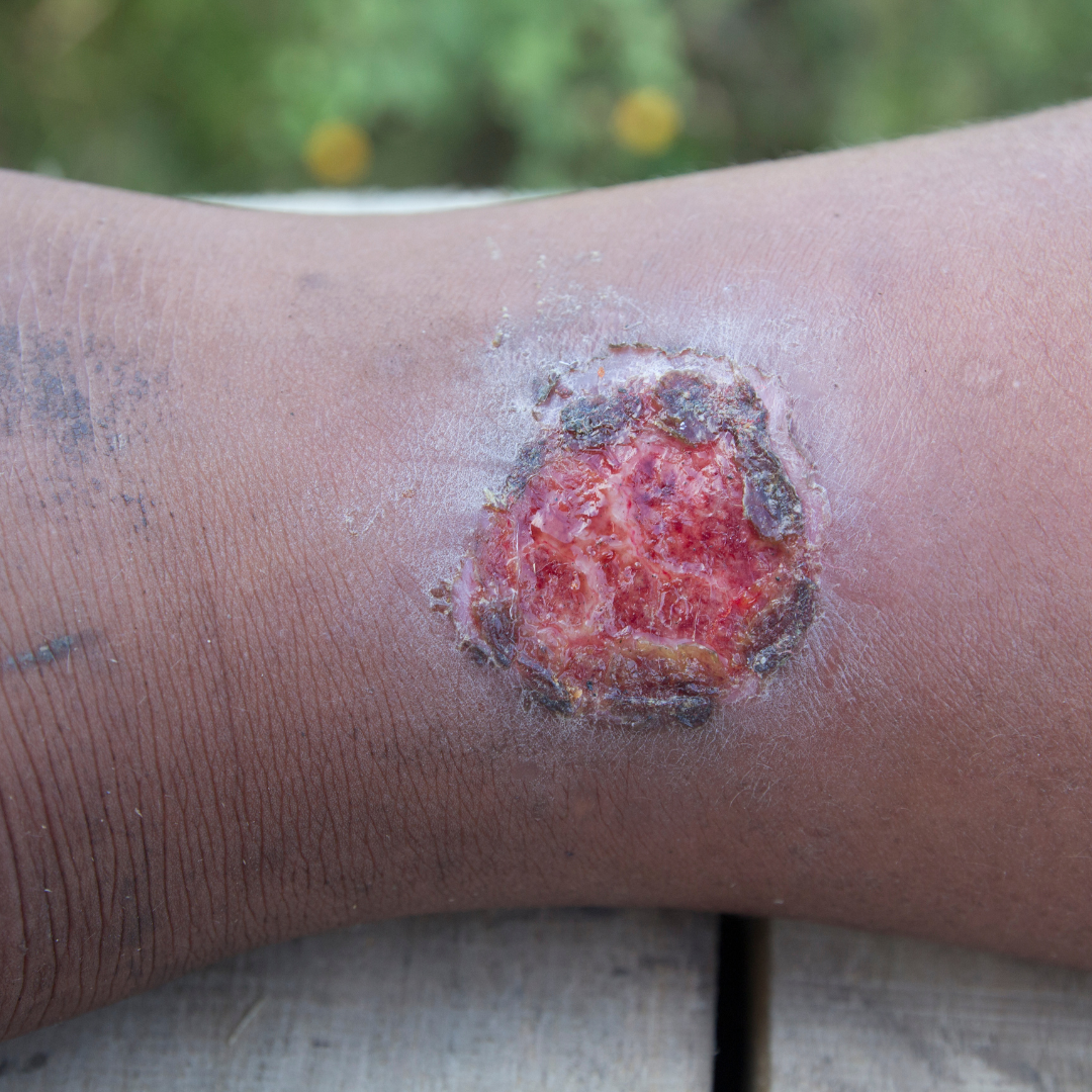 욕창 예방 치료 증상 원인