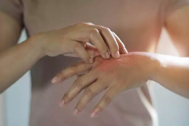 주부습진 치료법 연고