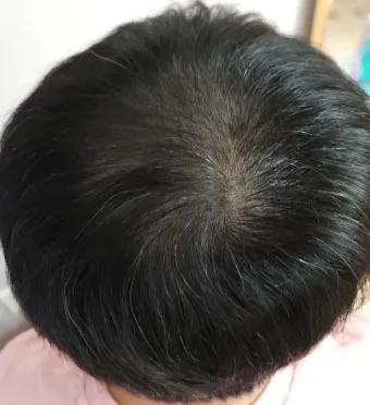 정수리가 아픈 이유와 완화하는 방법_15