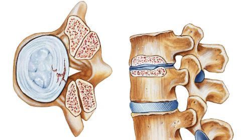 척추관협착증 자가진단 7가지 체크리스트 - 전문의가 알려주는 진짜 증상