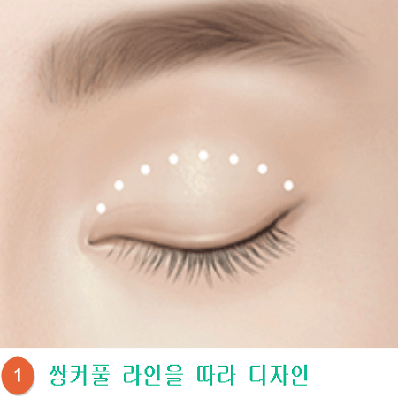 비절개 상안검 수술과정 첫번째