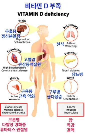 비타민D 부족증상_14