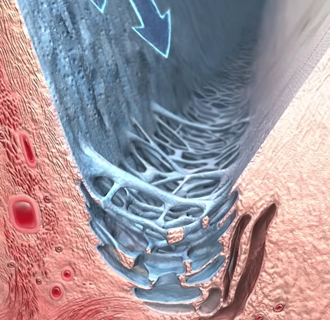 녹내장 초기증상