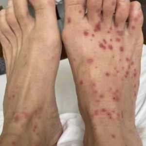 엠폭스 관련주 대장주 테마주 수혜주 TOP5