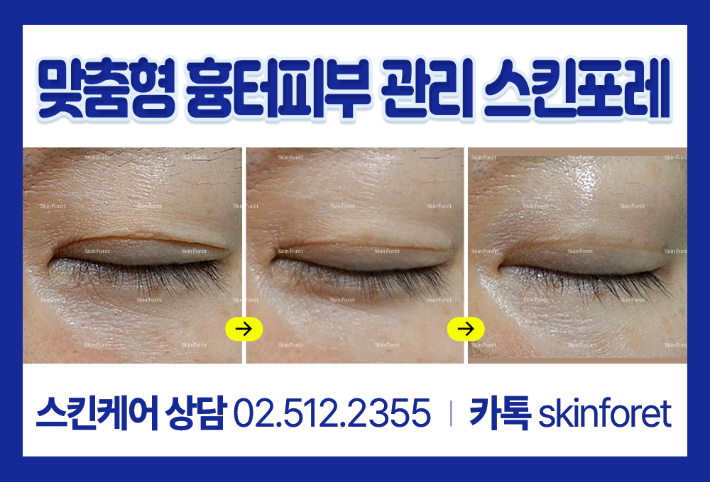 시간이 지난 눈가 흉터를 skinforet 전후로 비교한 쌍꺼풀흉터 과정 사례