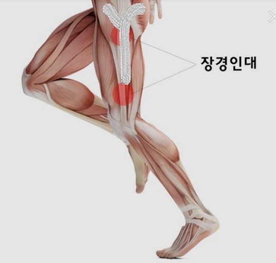 장경인대증후군