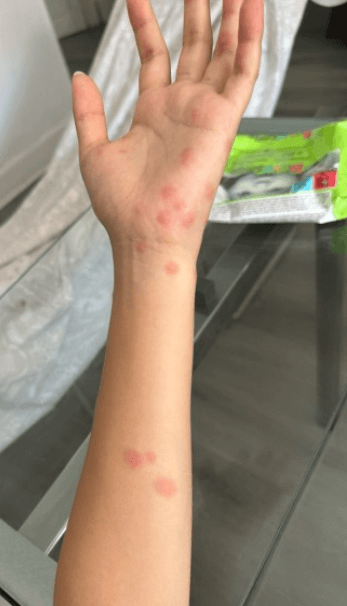 여행중빈대(베드버그)피하는법-빈대피하기수칙