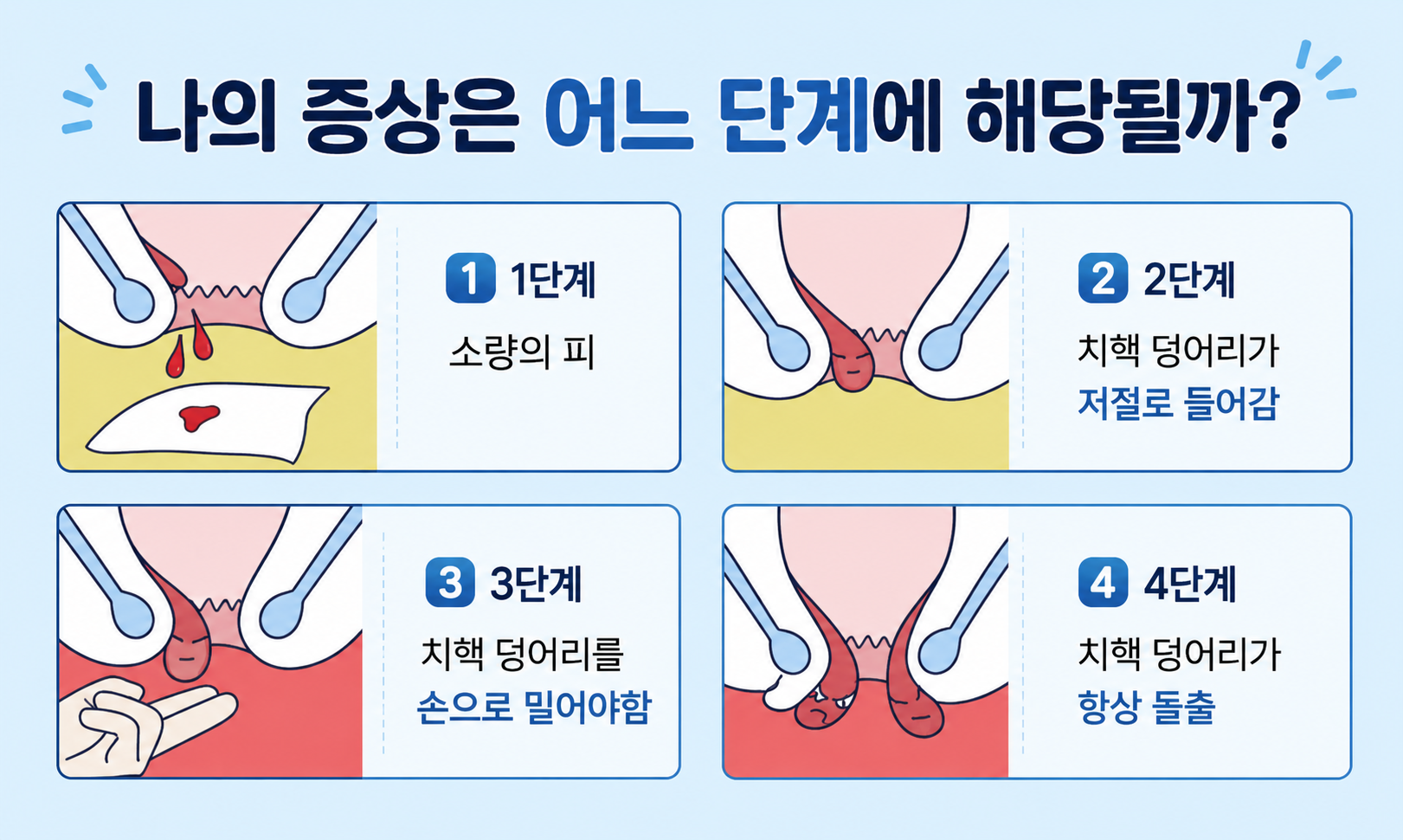 치질의 단계별 주요 증상
