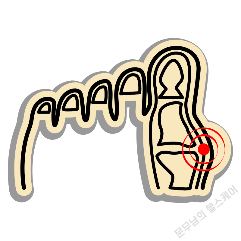 엄지발가락 옆 통증 원인 무지외반증