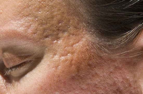 패인 흉터 관리: 효과적인 치료 방법과 관리 팁