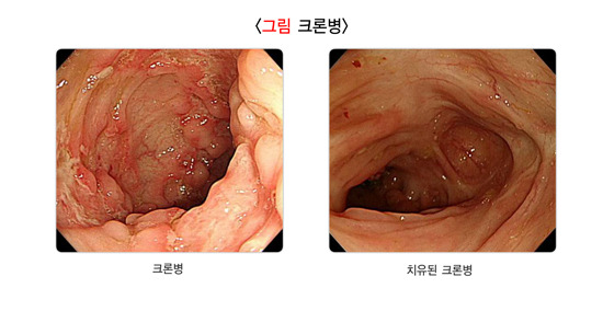 크론병