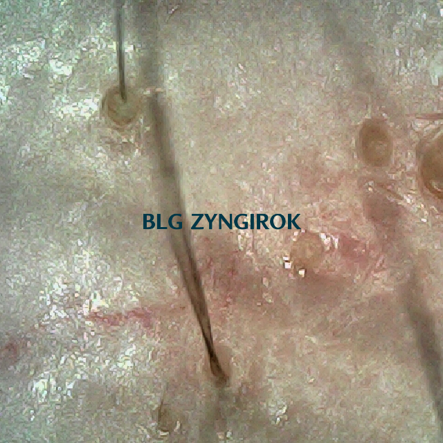 피나모아 복용 16주차 - 오른쪽 M자 부위 두피모습이다.