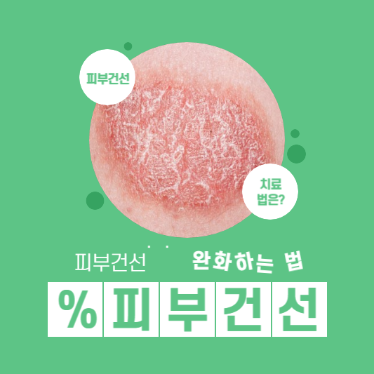 피부건선 증상 완화법