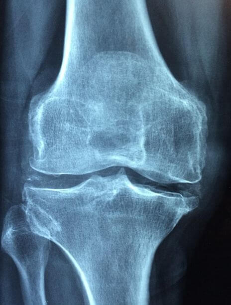 골다공증 치료방법 및 검사비용