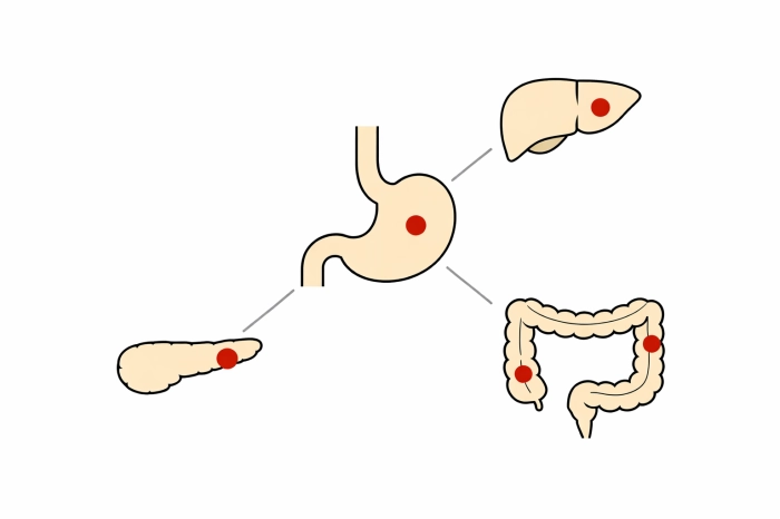 암환자 산정특례 제도