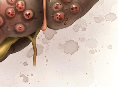 간경화 초기증상