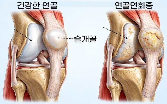 연골연화증이란