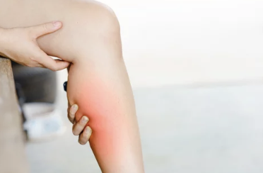 종아리 근육 통증의 증상