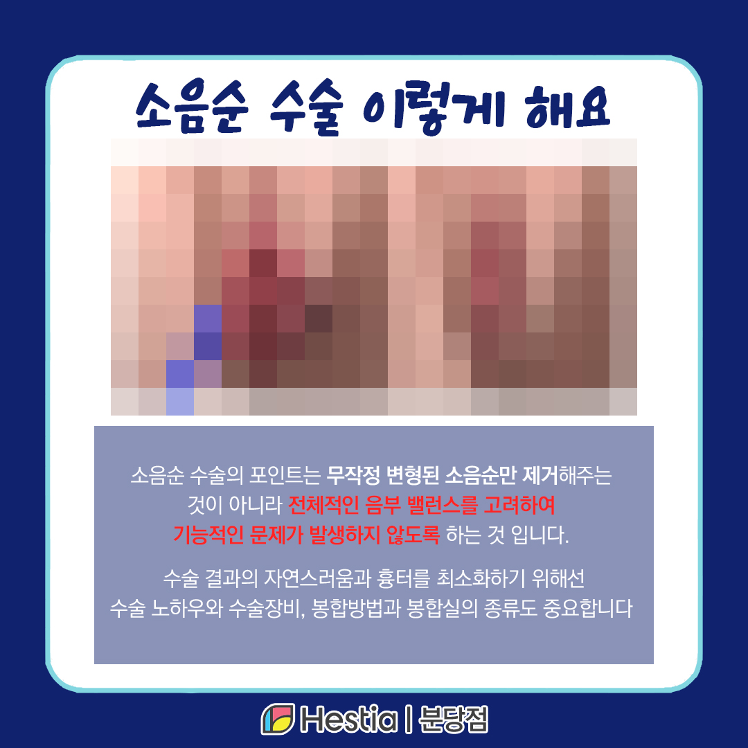 서현역산부인과 소음순 날개 출산 후 소음순 소음순 수술 이렇게 해요