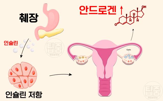 다낭성난소증후군 증상 자가진단 인슐린저항성 여자 살찌는병