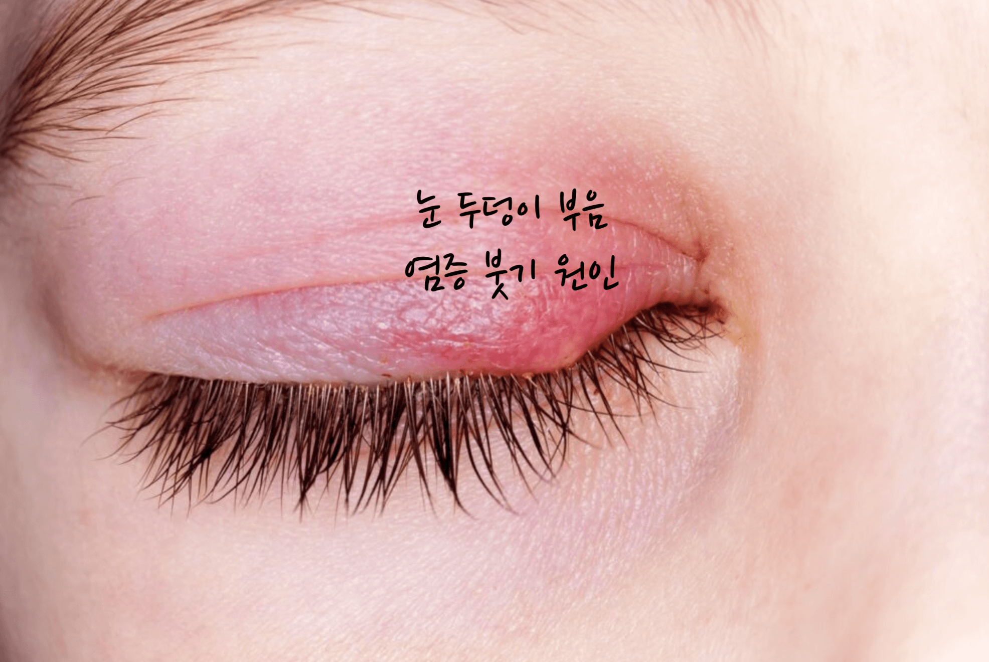 눈 두덩이 부음