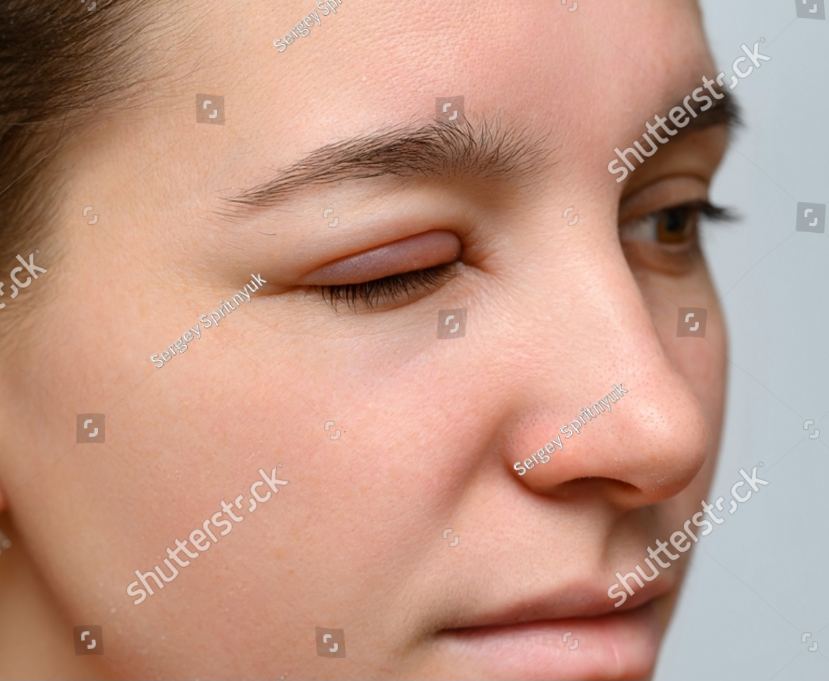 다래끼의 올바른 이해