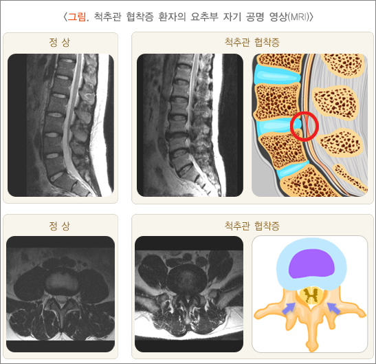 척추관 협착증 요추부 자기공명영상