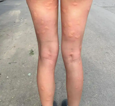 등산 갔다가 벌레 물림 부음&amp;#44; 따가움 때문에 벌레약 다 써보고 평가해 봤다
