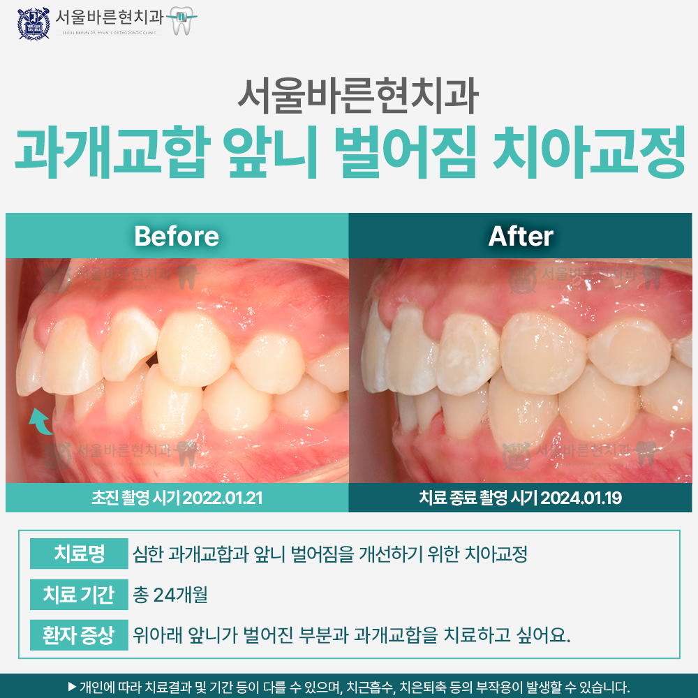 해운대치아교정