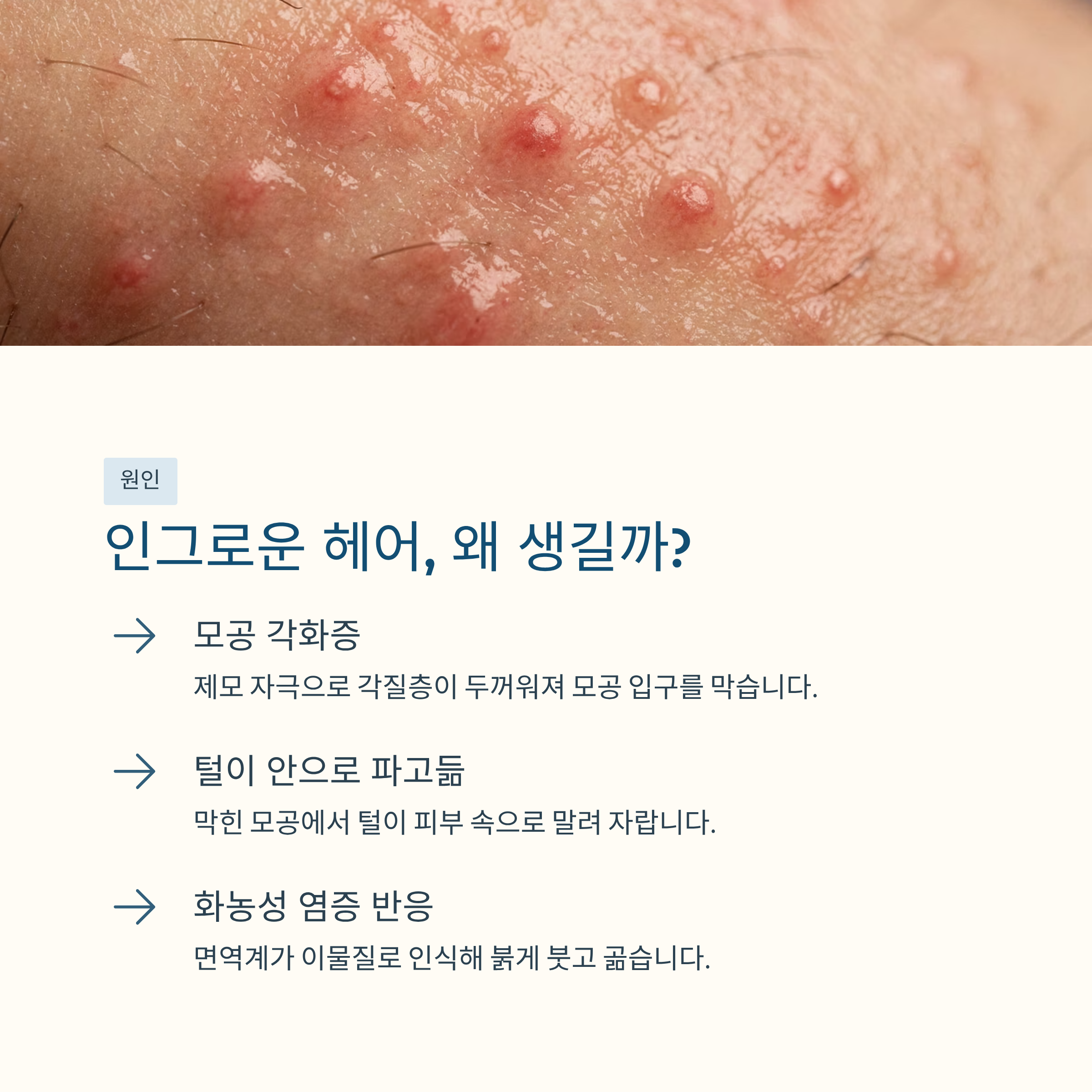 인그로운 헤어