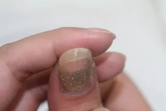 손톱이 갈라지는 이유 원인 증상 대처법_13