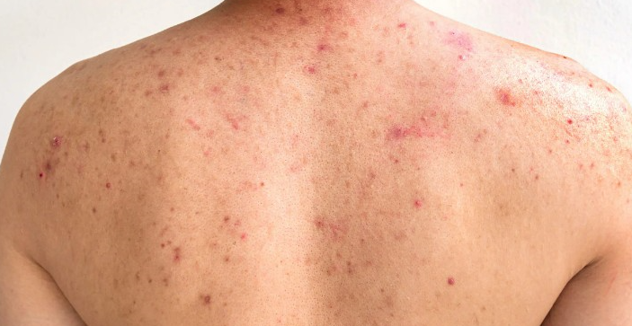 등드름 가드름 없애는 방법