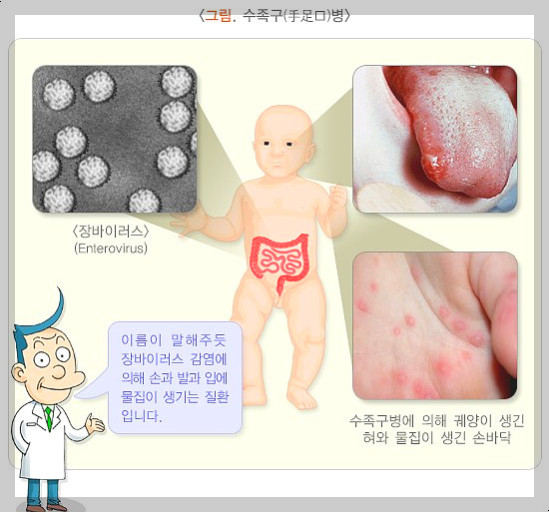 수족구병: 원인, 증상, 예방 및 관리 방법 총정리
