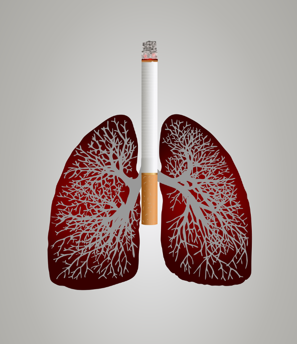 폐암과 관련된 사진