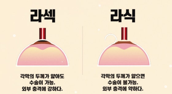 라식, 라섹 뭐가 다르나? 시력교정 수술 완전 비교 관련 사진