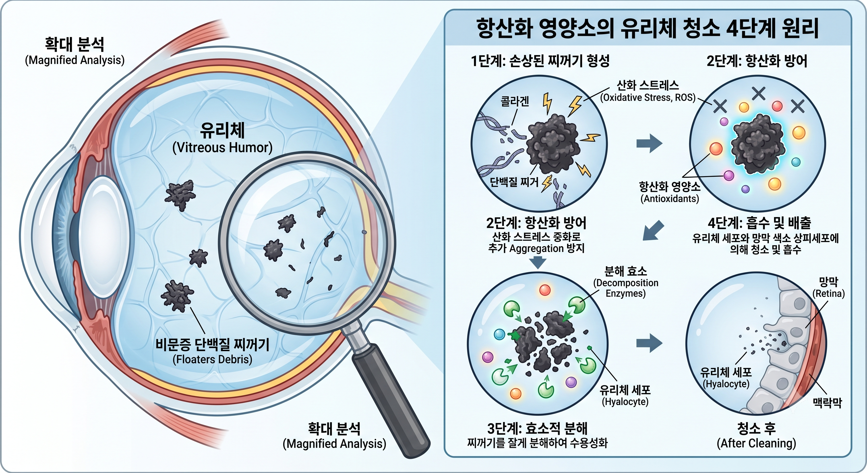 투명한 안구 유리체 안에서 항산화 영양소들이 까만 단백질 찌꺼기를 분해하고 청소하는 원리 그래픽