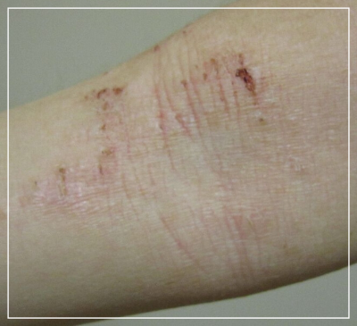 가려운 팔의 모습