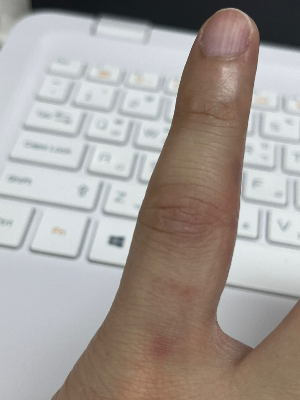 멍든내손가락-욱씬욱씬