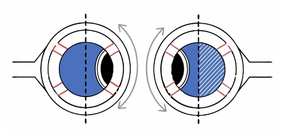 녹내장수술 전과정