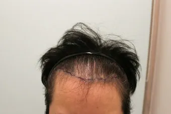 머리카락 이식 3000모 3000모낭 비용과 시술 과정_13