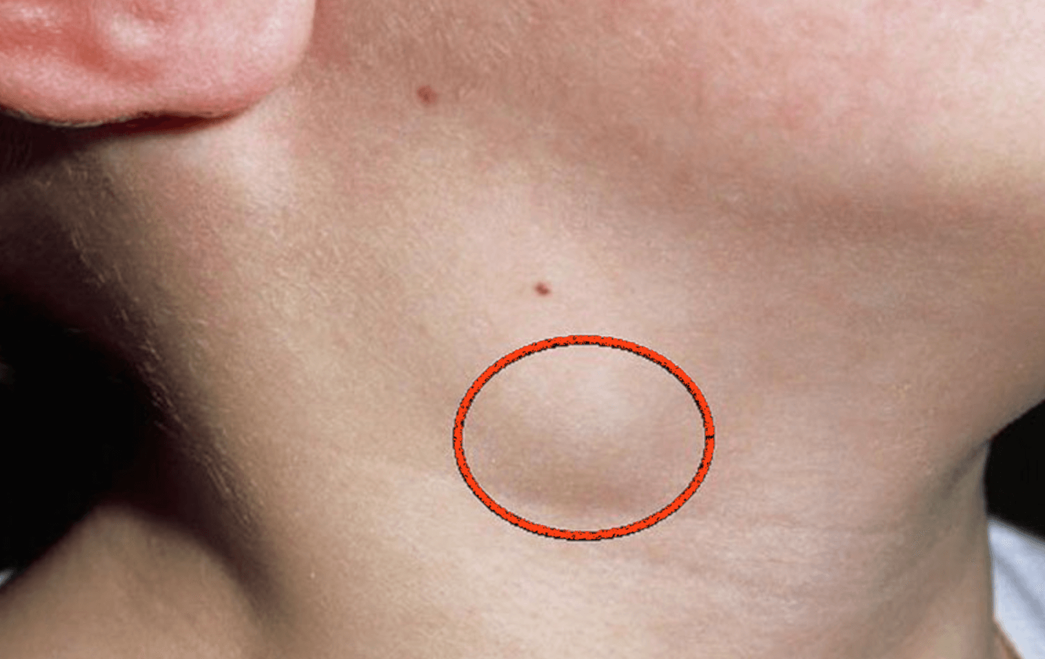 턱밑 멍울 통증