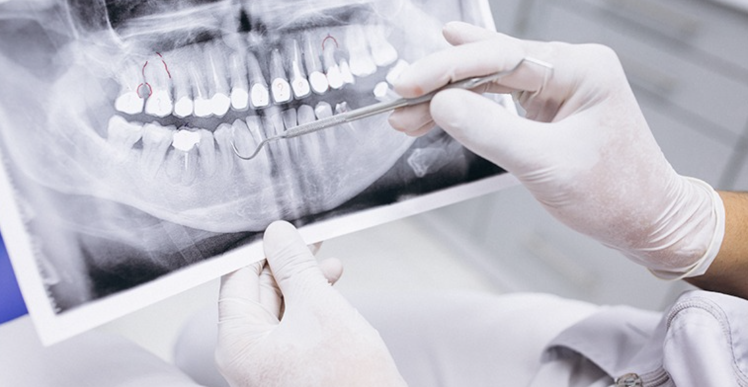 치아-임플란트-엑스레이-사진