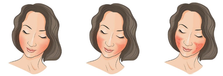 주사피부염-주사비