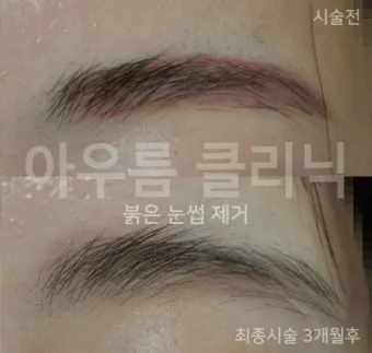 눈썹 문신 제거 방법 꿀팁_15